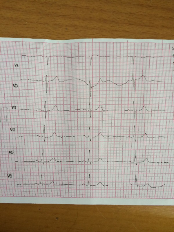 心率50突发眩晕呕吐：心率40头晕想呕吐什么原因 